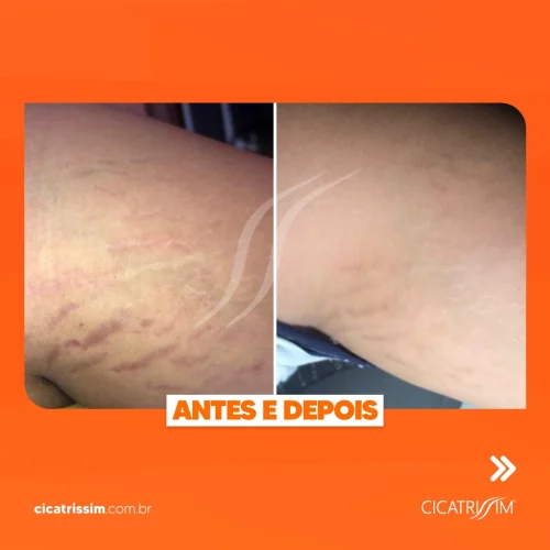 Cicatrissim dep 1