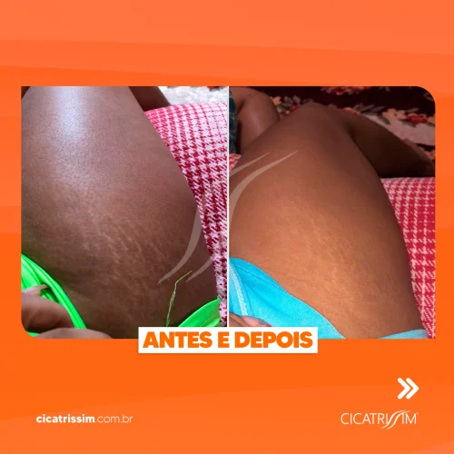 Cicatrissim dep 10