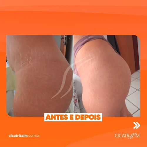 Cicatrissim dep 11