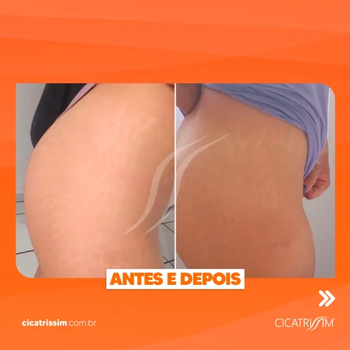 Cicatrissim dep 12