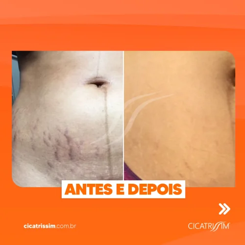 Cicatrissim dep 13