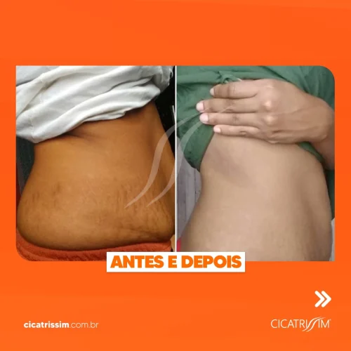 Cicatrissim dep 15