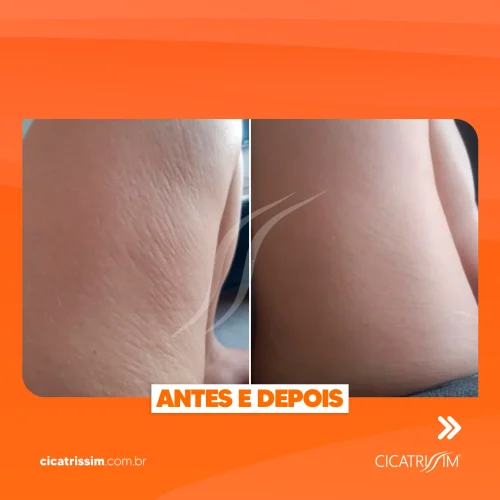 Cicatrissim dep 2