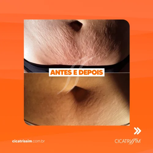 Cicatrissim dep 6